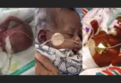 Copii născuți la 21 de săptămâni care au supraviețuit – mărturii care ajută medicina să progreseze